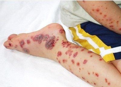 افزایش آمار مبتلایان و جانباختگان تب کریمه در ایران ، 6 نفر فوت کردند ، این علائم جدی گرفته شود